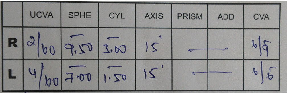 Single Vision - Astigmatism